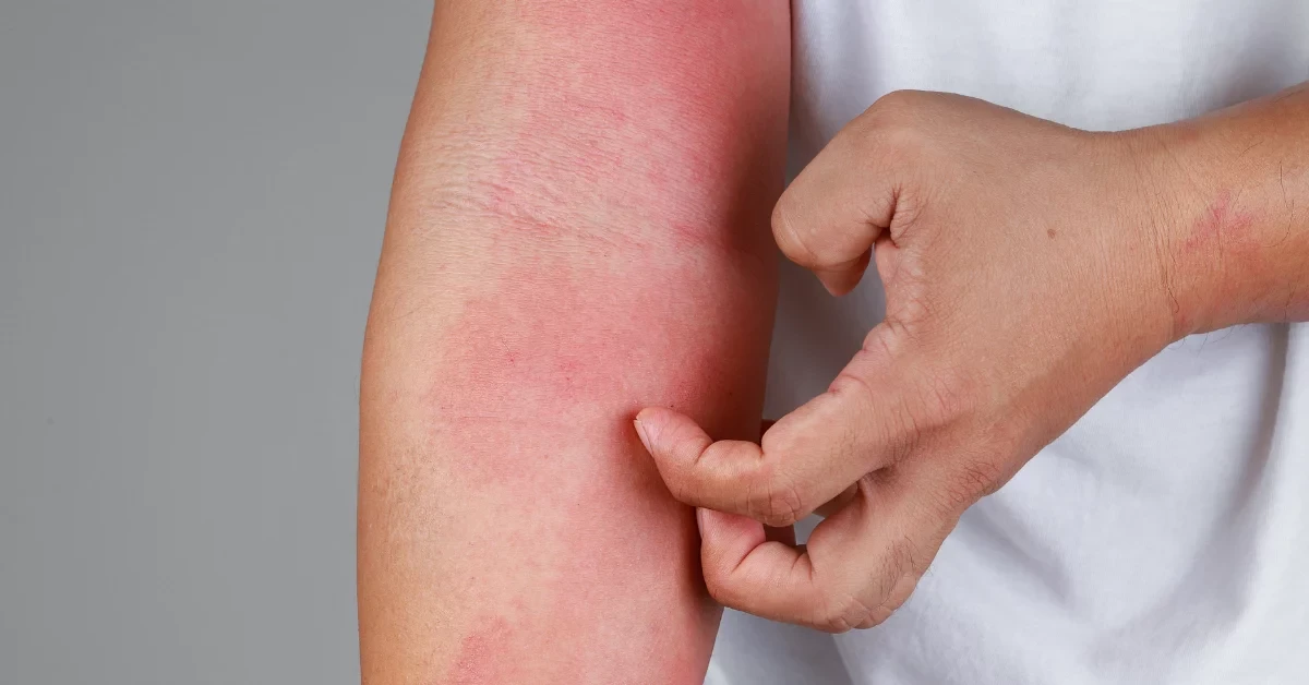 Eczema psoriasis skin treatment Klinik Bustari Kuching